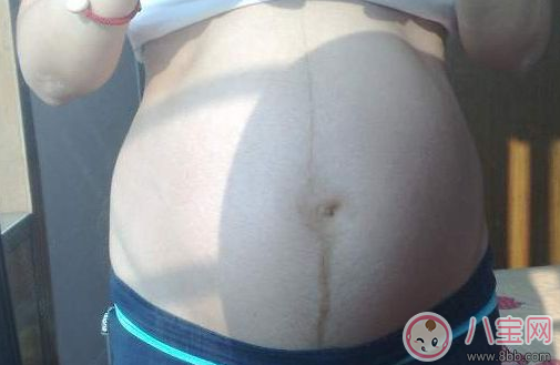 怎么通過妊娠紋判斷懷的是男是女    妊娠紋判斷性別方法