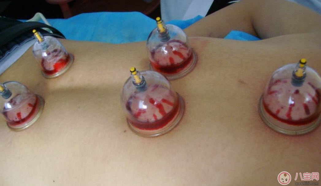 孕婦拔火罐可以嗎 孕婦肩膀能拔火罐嗎(孕婦拔過火罐怎么辦)