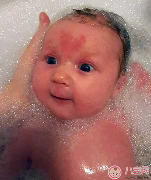 其實(shí)在懷孕的時候注意好 寶寶也會不長胎記