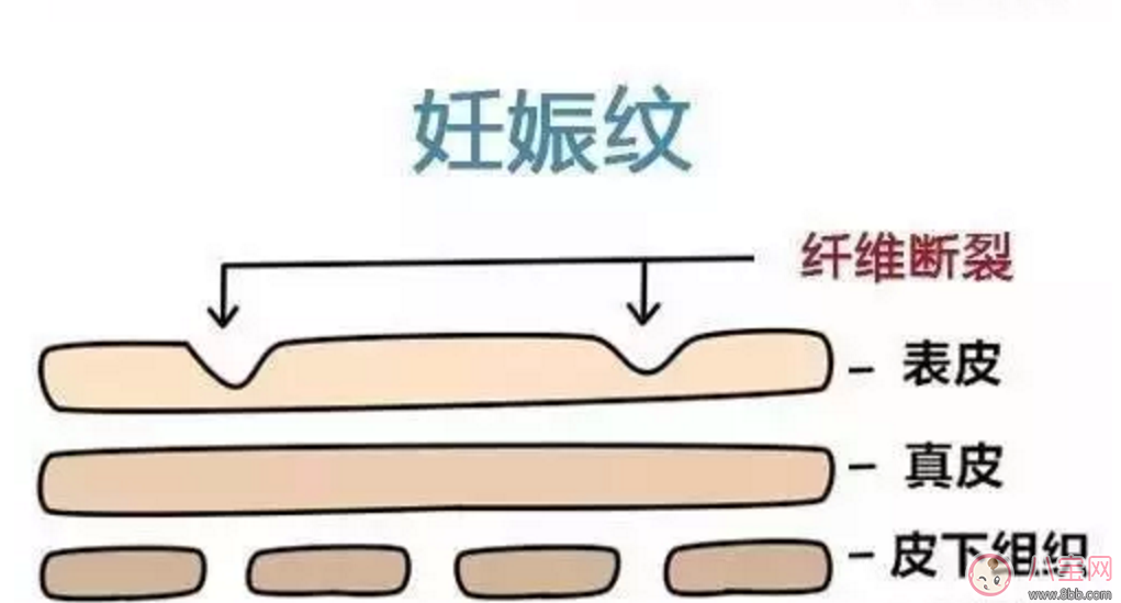 擺脫妊娠紋  哪些方法容易又簡(jiǎn)單