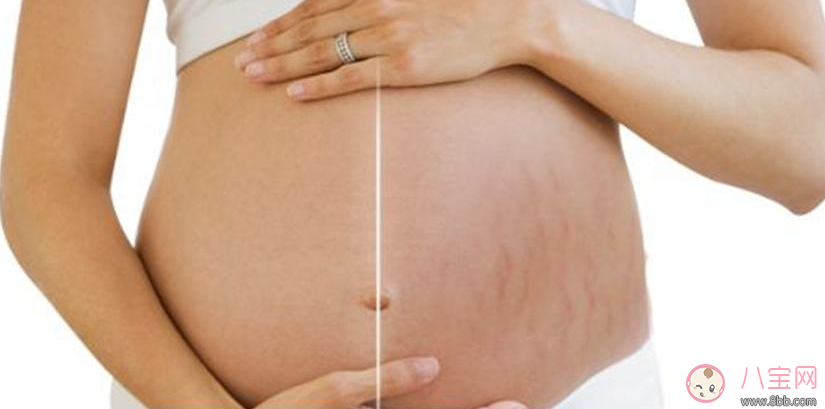 這些人居然天生不長(zhǎng)妊娠紋 不長(zhǎng)妊娠紋的奧秘是什么