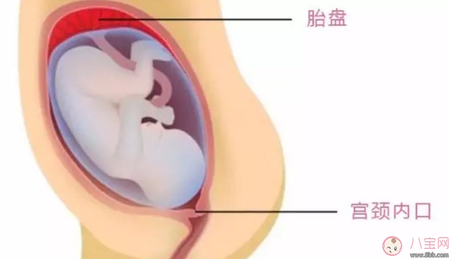 孕婦胎盤低怎么辦 孕婦胎盤低是什么原因造成的(胎盤低要注意什么)