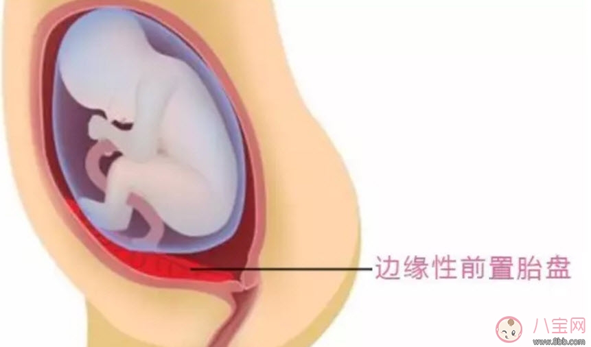 孕婦胎盤低怎么辦 孕婦胎盤低是什么原因造成的(胎盤低要注意什么)