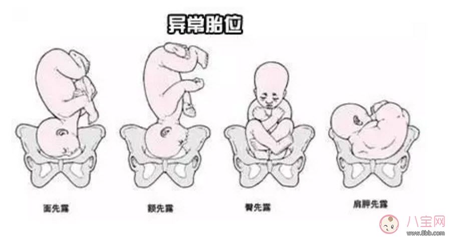 孕期胎位不正的原因 如何矯正胎位不正