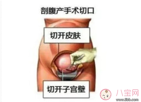 剖腹產(chǎn)孕婦會(huì)不會(huì)感到疼痛 剖腹產(chǎn)橫剖還是縱剖。