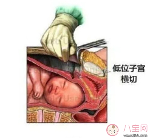 剖腹產(chǎn)孕婦會(huì)不會(huì)感到疼痛 剖腹產(chǎn)橫剖還是縱剖。
