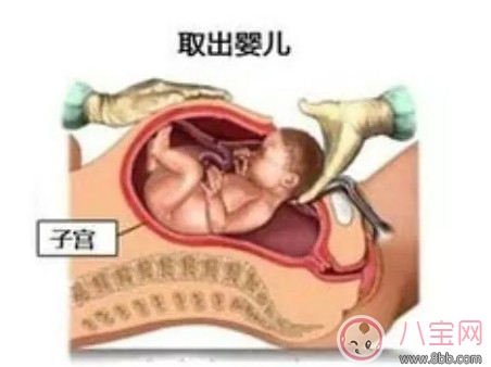 剖腹產(chǎn)孕婦會(huì)不會(huì)感到疼痛 剖腹產(chǎn)橫剖還是縱剖。