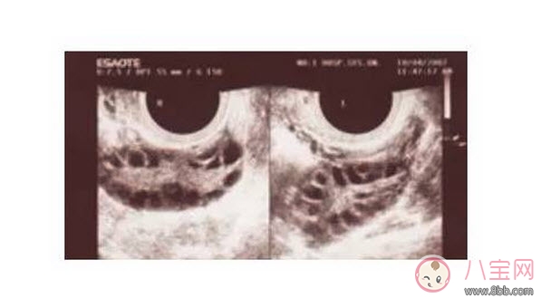 昆凌三胎計(jì)劃，昆凌多囊性卵巢癥候群是什么病