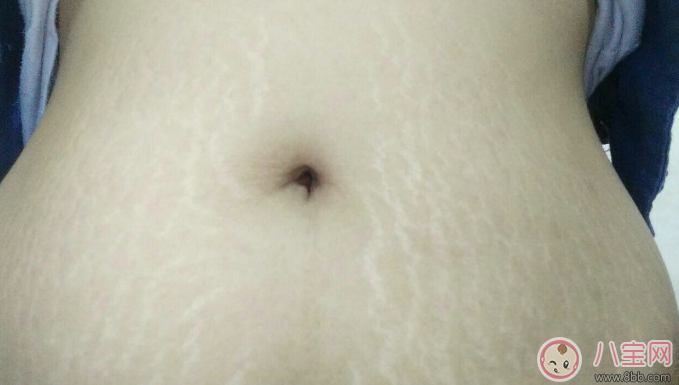 孕辰紋怎么消除 這些產(chǎn)品防止孕辰紋產(chǎn)生和消除孕辰紋