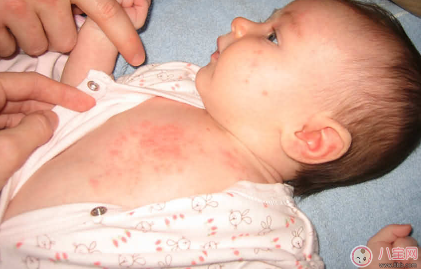 寶寶痱子總不消 用用這個準會好