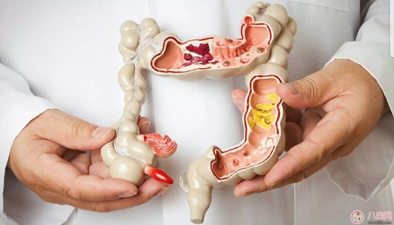 大腸癌常見癥狀 如何預防大腸癌