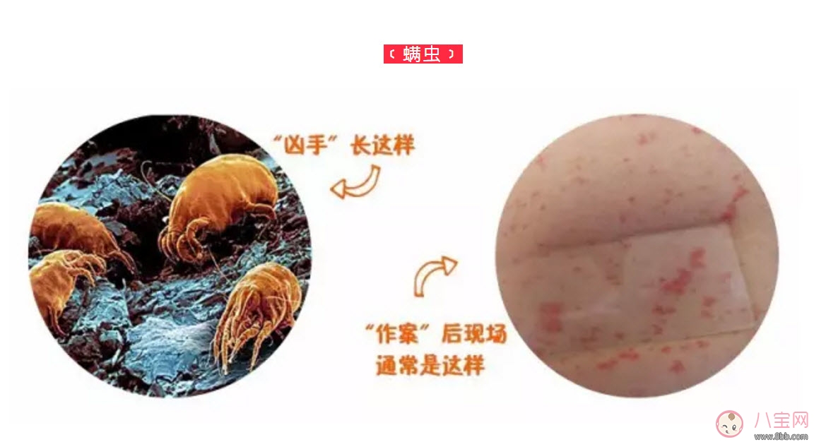 寶寶螨蟲過敏怎么辦，寶寶被螨蟲咬和蚊子咬癥狀對比圖片區(qū)別