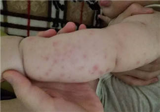 寶寶螨蟲過(guò)敏怎么辦，寶寶被螨蟲咬和蚊子咬癥狀對(duì)比圖片區(qū)別