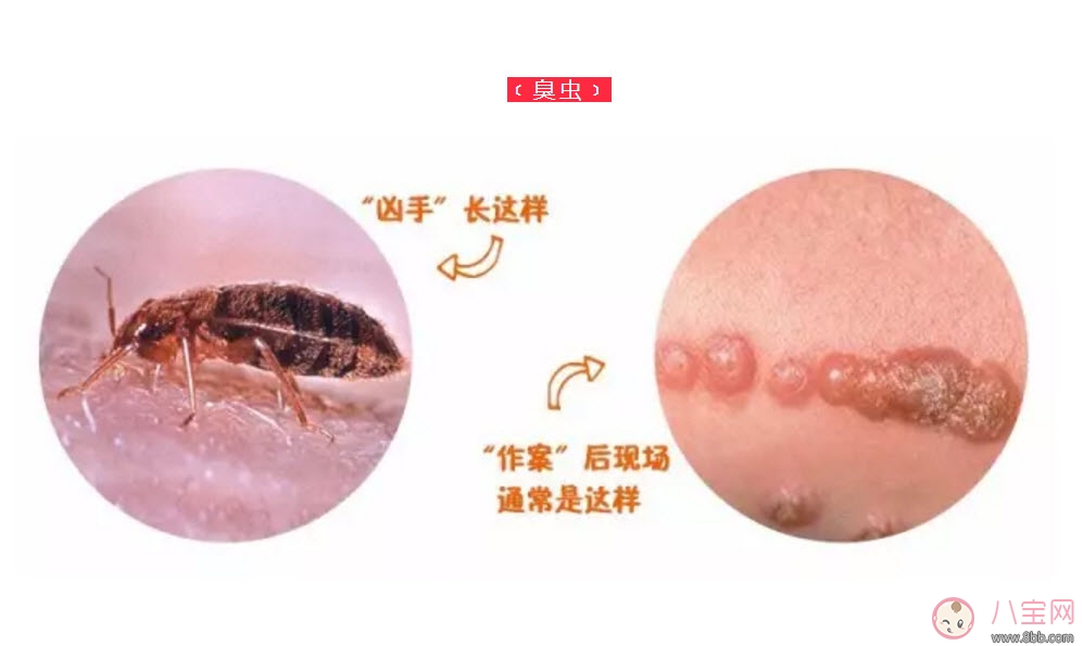 寶寶被臭蟲(chóng)咬了癥狀圖片 寶寶被臭蟲(chóng)咬和蚊子咬癥狀對(duì)比圖片區(qū)別