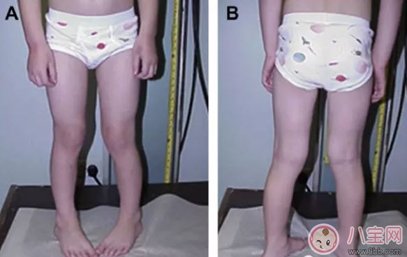 寶寶走路內(nèi)八字怎么辦 寶寶走路內(nèi)八字的原因有哪些