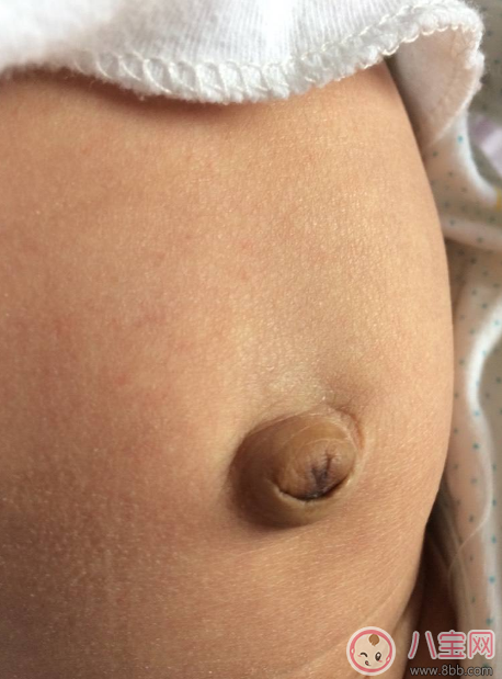 孩子肚子鼓的像個氣球 寶寶臍疝別忽視 孩子肚子鼓的像個氣球 寶寶臍疝別忽視