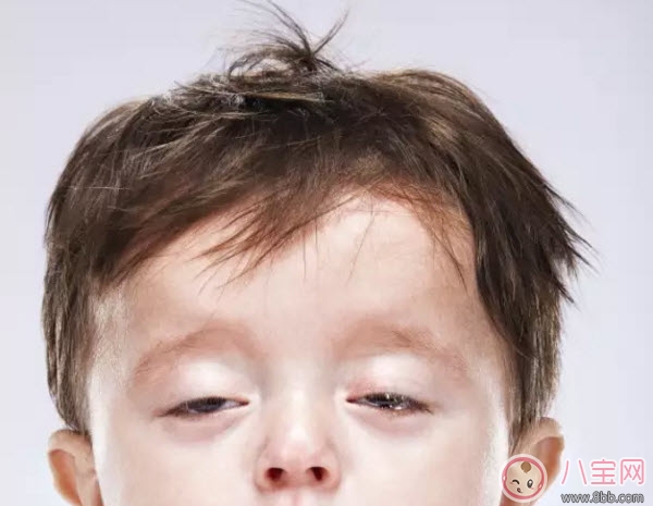 嬰兒鬼臉綜合癥癥狀圖有哪些 過量補鈣造成鬼臉綜合癥的危害是什么