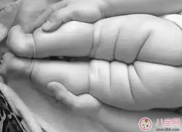 寶寶臀紋不對稱怎么回事 臀紋不對稱一定是髖關(guān)節(jié)發(fā)育不良嗎