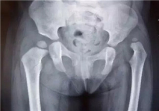 寶寶臀紋不對(duì)稱(chēng)怎么回事 臀紋不對(duì)稱(chēng)一定是髖關(guān)節(jié)發(fā)育不良嗎