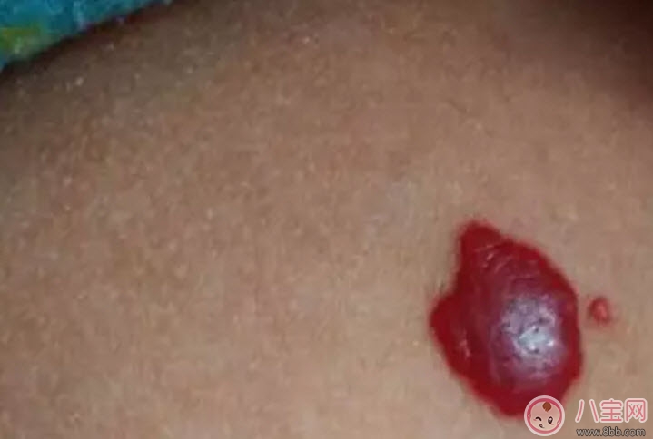 新生兒紅色胎記和血管瘤的對比方法 寶寶胎記和血管瘤的區(qū)別