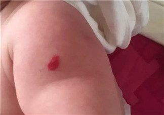 新生兒紅色胎記和血管瘤的對比方法 寶寶胎記和血管瘤的區(qū)別
