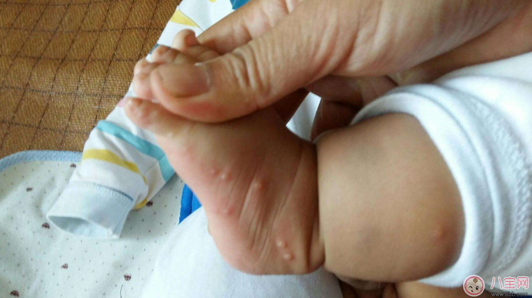 孩子長水痘這些東西千萬遠(yuǎn)離 孩子水痘好得快方法 孩子長水痘這些東西千萬遠(yuǎn)離 孩子水痘好得快方法