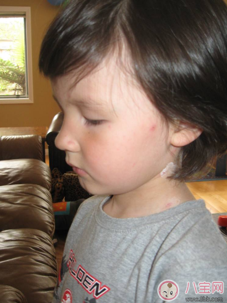 孩子長水痘這些東西千萬遠(yuǎn)離 孩子水痘好得快方法 孩子長水痘這些東西千萬遠(yuǎn)離 孩子水痘好得快方法