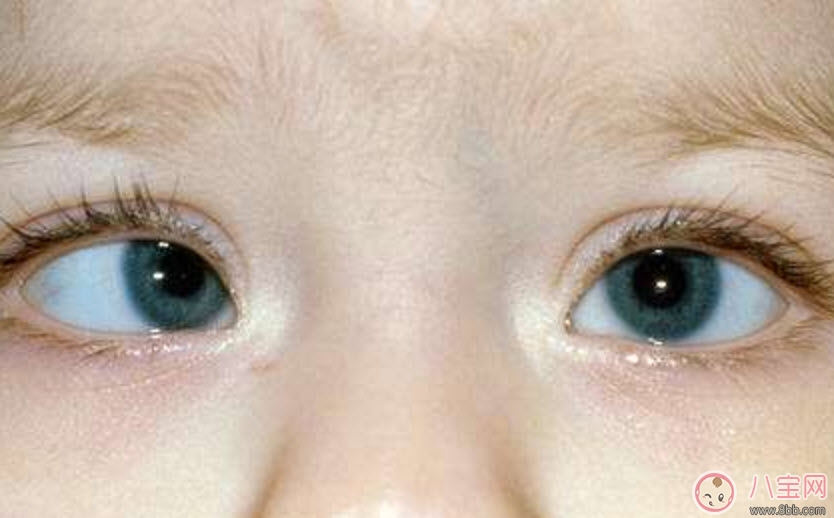 寶寶斜視手術(shù)風險大嗎 寶寶斜視一定要做手術(shù)嗎