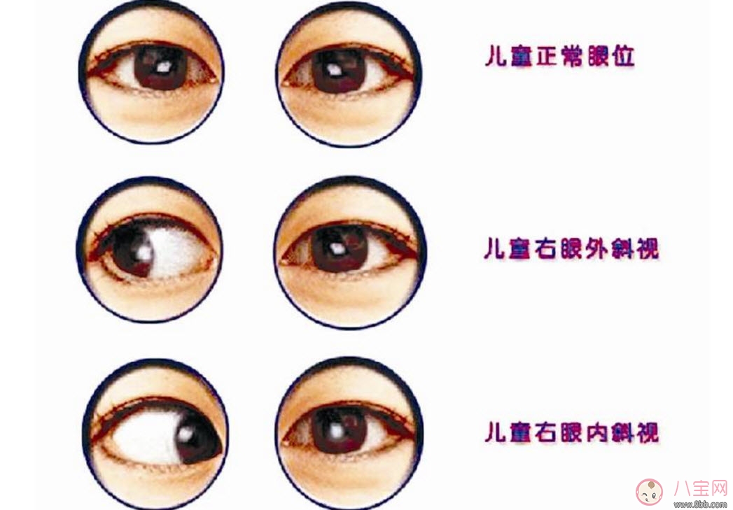 寶寶斜視手術(shù)風險大嗎 寶寶斜視一定要做手術(shù)嗎