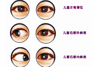 寶寶斜視手術(shù)風(fēng)險(xiǎn)大嗎 寶寶斜視一定要做手術(shù)嗎