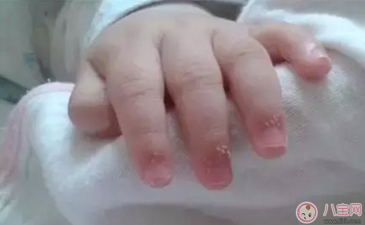 寶寶手上長肉刺是因?yàn)槿狈I養(yǎng)嗎 寶寶手指上長倒刺是什么原因