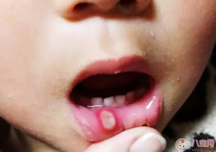 寶寶口腔潰瘍怎么辦 寶寶口腔潰瘍吃什么好的快 寶寶口腔潰瘍怎么辦 寶寶口腔潰瘍吃什么好的快