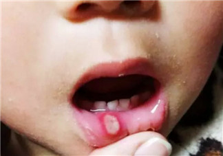 寶寶口腔潰瘍?cè)趺崔k 寶寶口腔潰瘍吃什么好的快