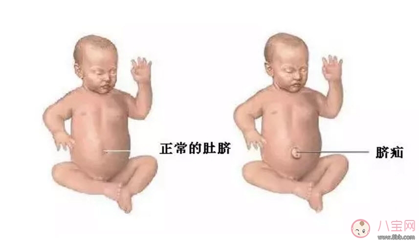 臍疝對(duì)寶寶有什么影響 寶寶臍疝是什么原因引起的