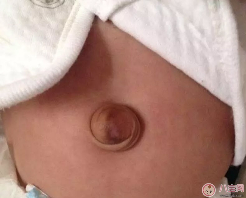 臍疝對(duì)寶寶有什么影響 寶寶臍疝是什么原因引起的