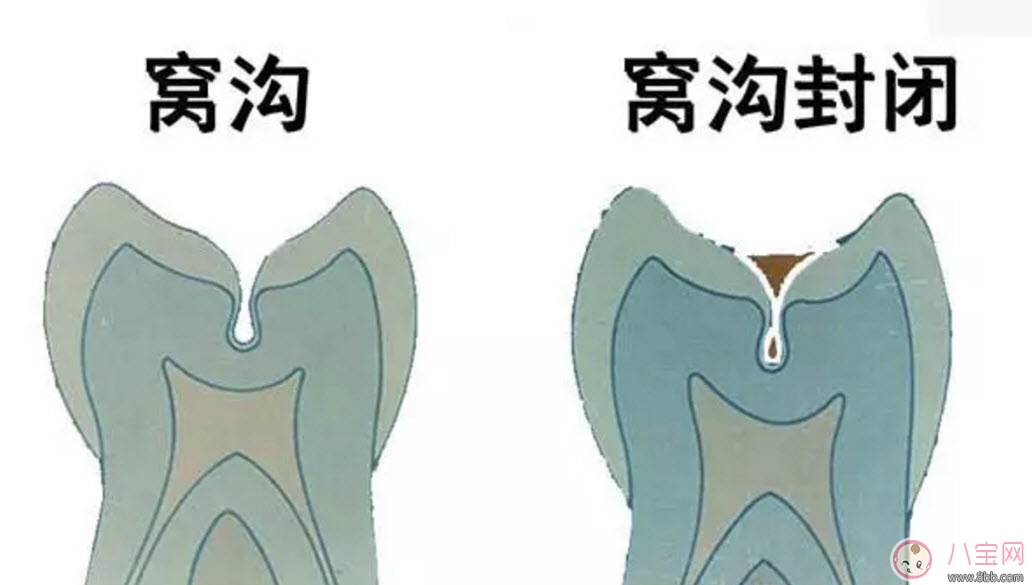 寶寶幾歲做窩溝封閉 兒童做窩溝封閉好不好