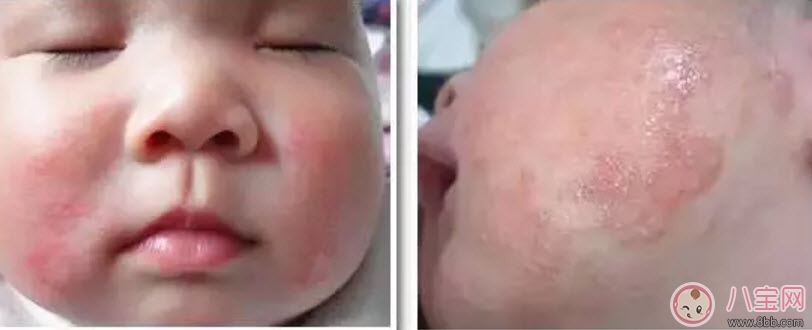 寶寶痱子和濕疹的區(qū)別 寶寶濕疹和痱子最大的不同是什么