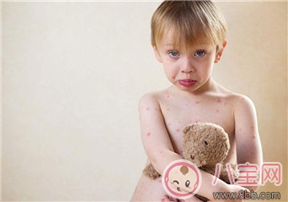 寶寶長(zhǎng)水痘的原因 如何發(fā)現(xiàn)寶寶長(zhǎng)水痘