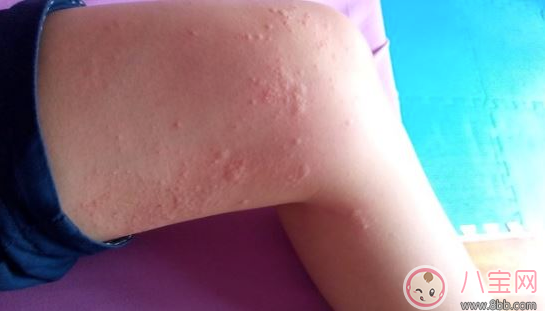 孩子玫瑰疹怎么護理 細心護理好得快