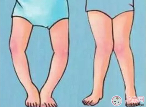 小兒佝僂病的癥狀 小兒佝僂病的預(yù)防治療