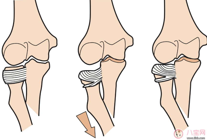 提孩子胳膊“蕩秋千”導(dǎo)致脫臼 孩子胳膊脫臼處理方法