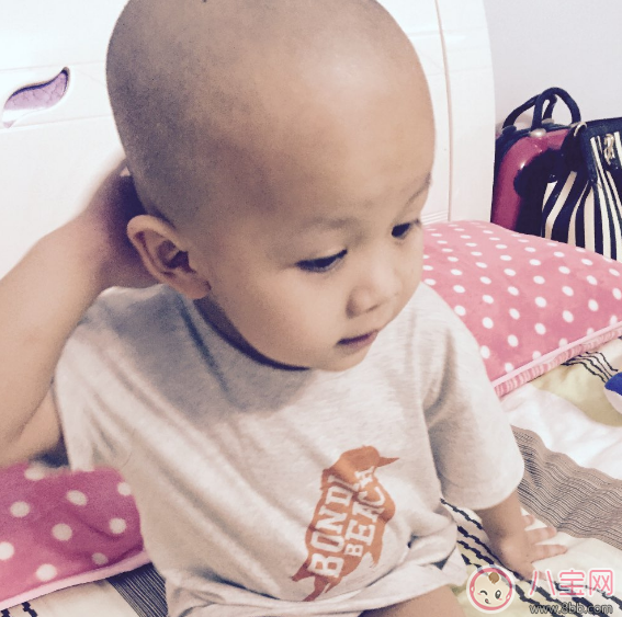孩子夏天剃光頭 小心一不小心變禿頭 孩子夏天剃光頭 小心一不小心變禿頭
