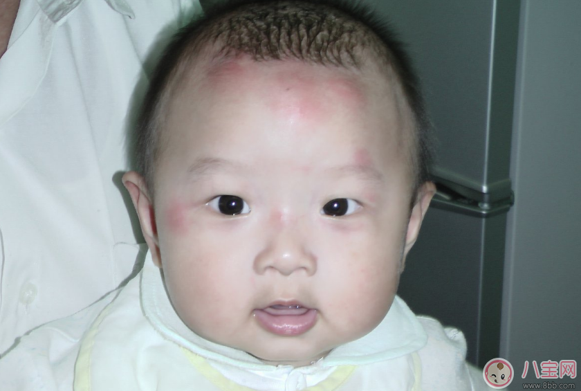 孩子用花露水竟然出現(xiàn)狀況 驅蚊給孩子用什么好