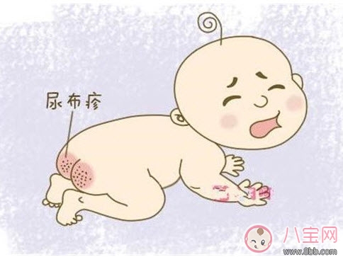 嬰兒長(zhǎng)尿布疹怎么辦 尿布疹是怎么引起的