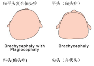 預(yù)防寶寶平頭扁頭 嬰兒如何塑造好頭型 定型枕頭沒用