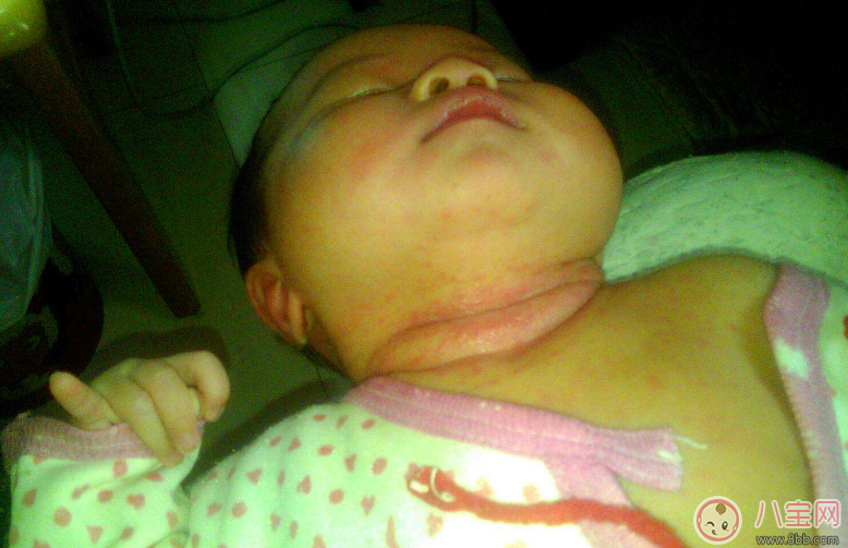 寶寶出汗脖子淹了怎么辦 嬰兒脖子淹了馬上好的土方法