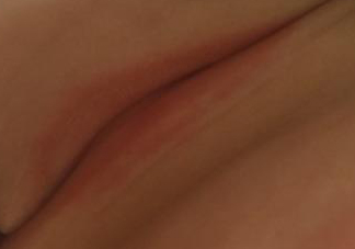 寶寶出汗脖子淹了怎么辦 嬰兒脖子淹了馬上好的土方法