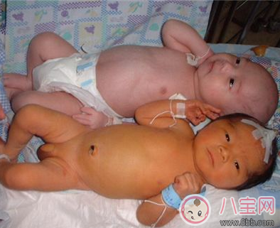 小兒黃疸嚴(yán)重嗎    黃疸怎么治