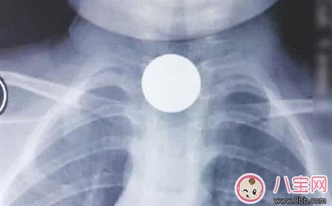 孩子誤吞硬幣的急救方法寶媽必知