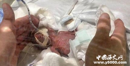 世界最小男嬰出院世界最小男嬰誕生的原因是什么？